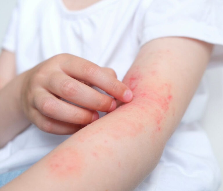 Dermatite Atopica